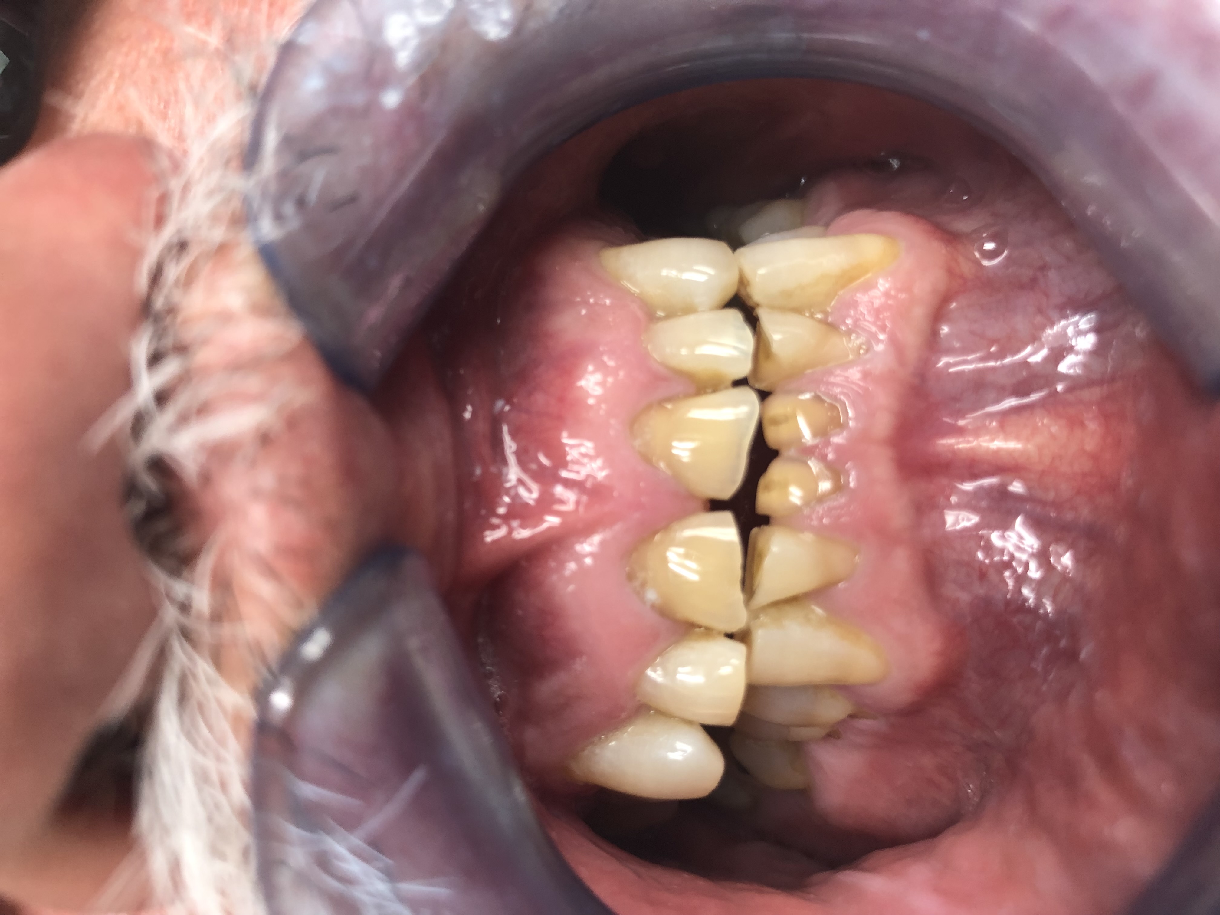 Before composite bonding